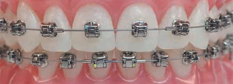 Teeth braces cost in Coimbatore